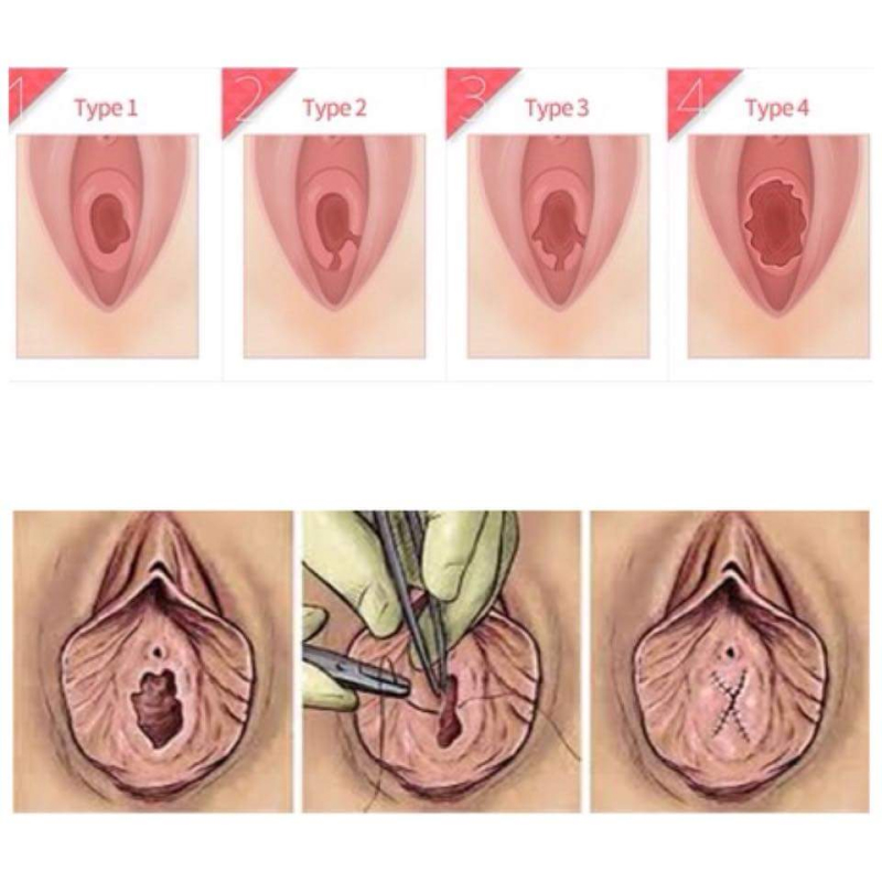 处女膜修复