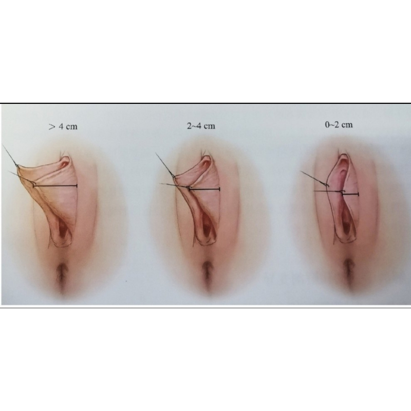 阴唇美型1